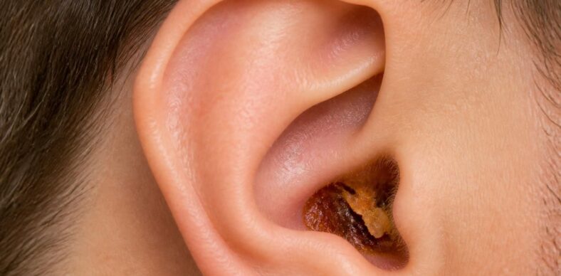 découvrez ce que la couleur du cérumen révèle sur la santé de vos oreilles et quand consulter un spécialiste.