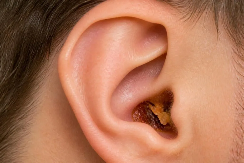 découvrez ce que la couleur du cérumen révèle sur la santé de vos oreilles et quand consulter un spécialiste.